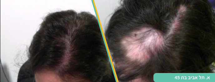 טיפול בנשירת שיער הייר קליניק
