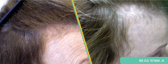 טיפול בנשירת שיער הייר קליניק